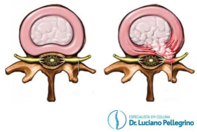 hérnia de disco