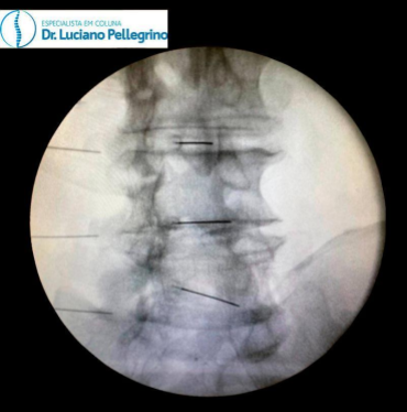 Infiltração na coluna para hérnia de disco