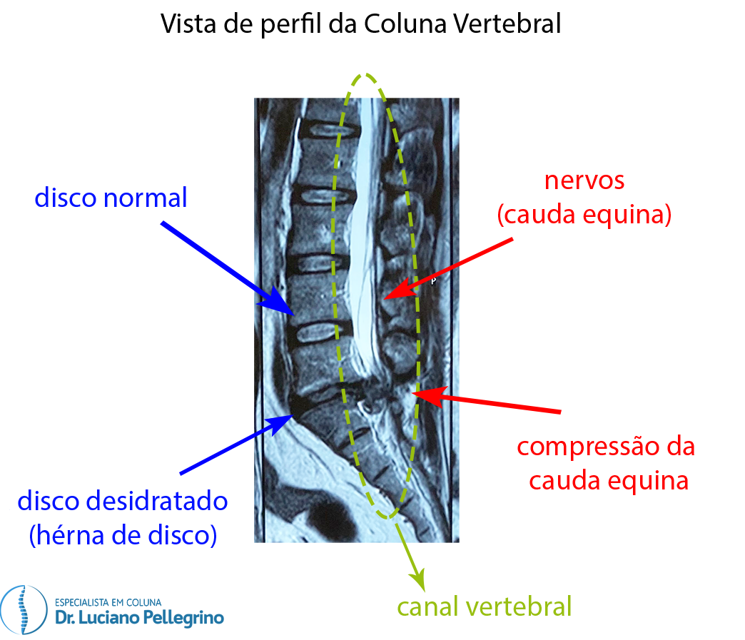 síndrome da cauda equina: imagem de ressonância magnética (perfil)