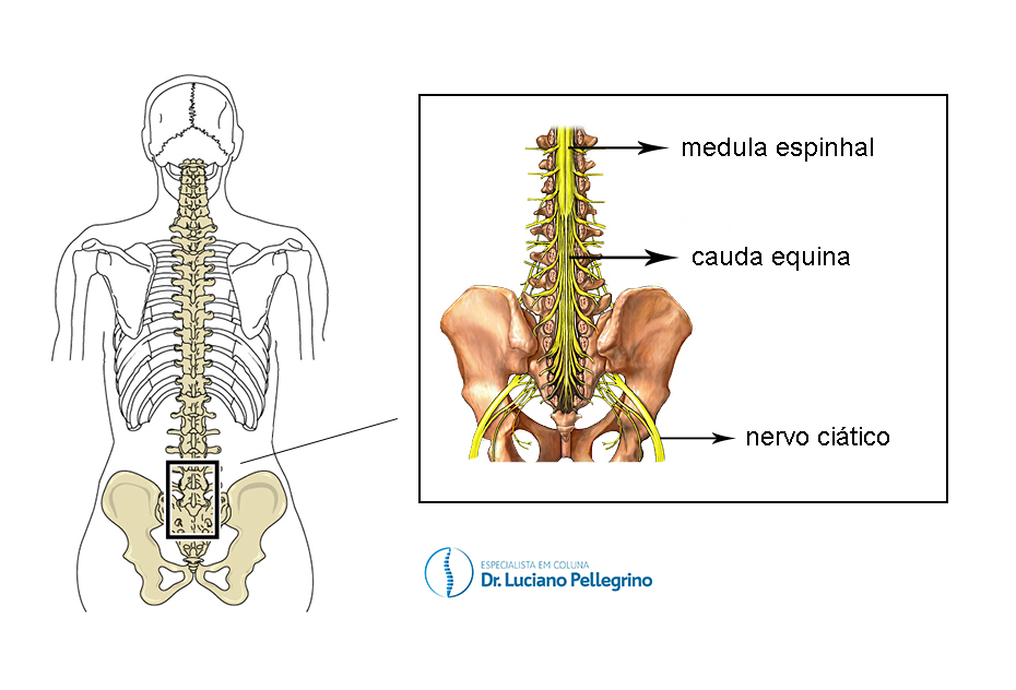 Síndrome da cauda equina