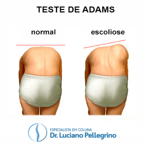 teste de adams