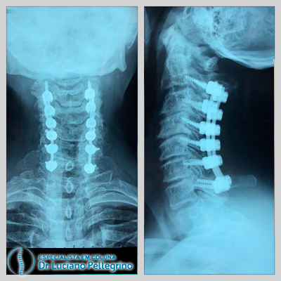 artrodese da coluna cervical posterior