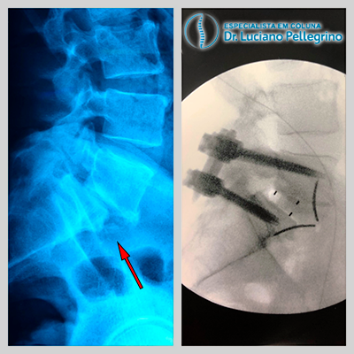 artrodese da coluna para espondilolistese ALIF