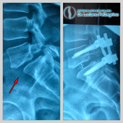 artrodese da coluna para espondilolistese TLIF