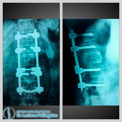 artrodese da coluna para fratura L1