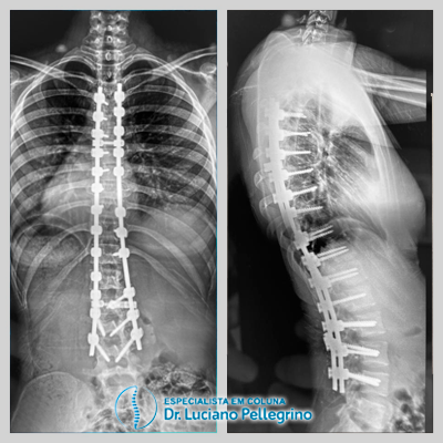 artrodese da coluna para escoliose