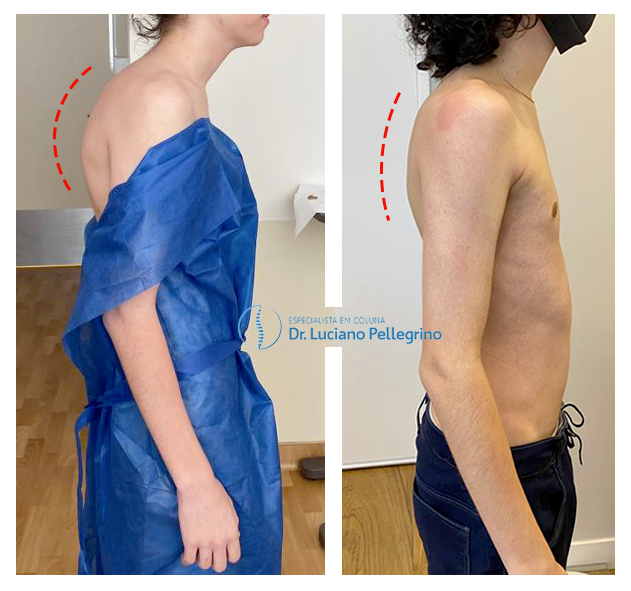 Antes e depois da cirurgia para correção da hipercifose