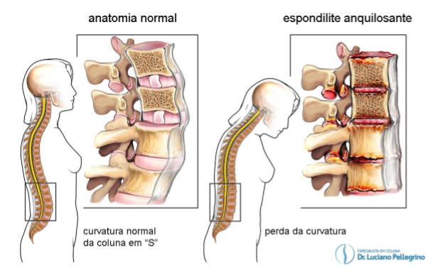 formação de cifose pela espondilite anquilosante