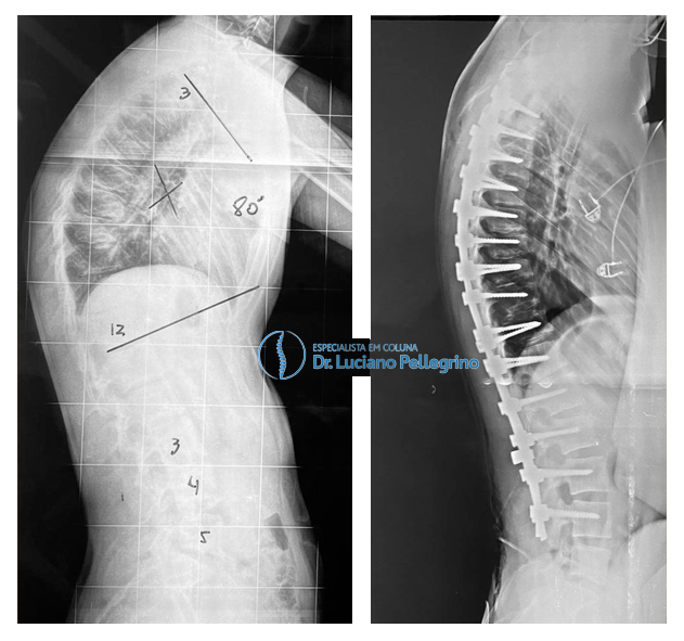 raio x do antes e depois da cirurgia de correção para corcunda