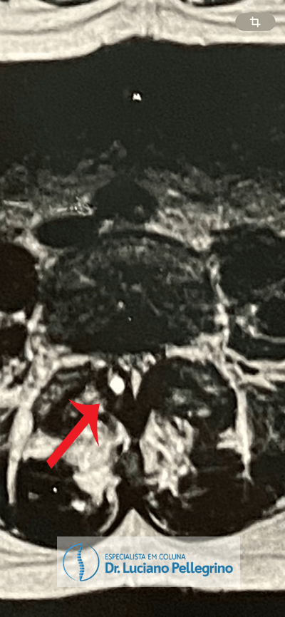 Cisto Sinovial na coluna: corte axial (transversal)