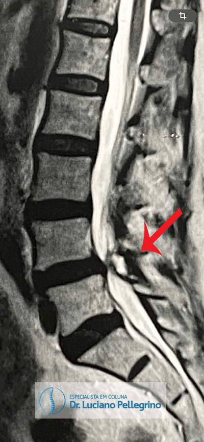 Cisto Sinovial na coluna: corte sagital (perfil)