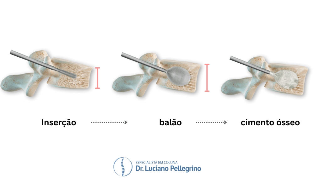 cirurgia cifoplastia