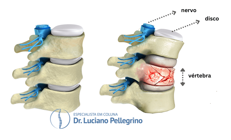 fratura vertebral por compressão