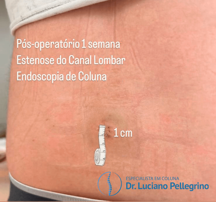 cicatriz pos-cirurgia