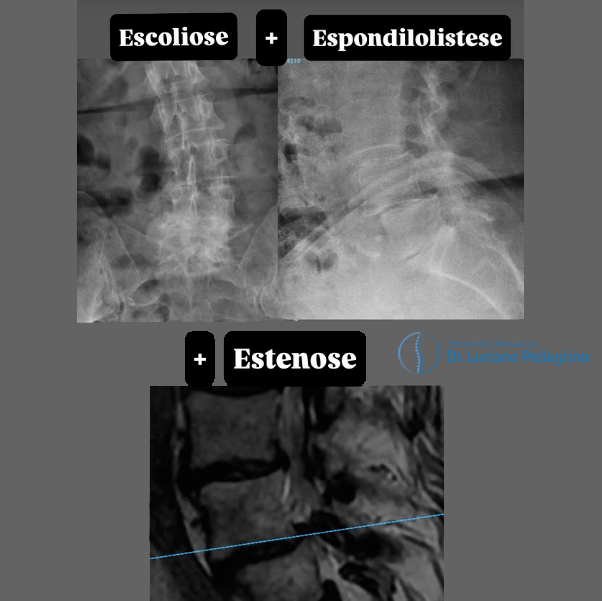 escoliose, espondilolistese, estenose