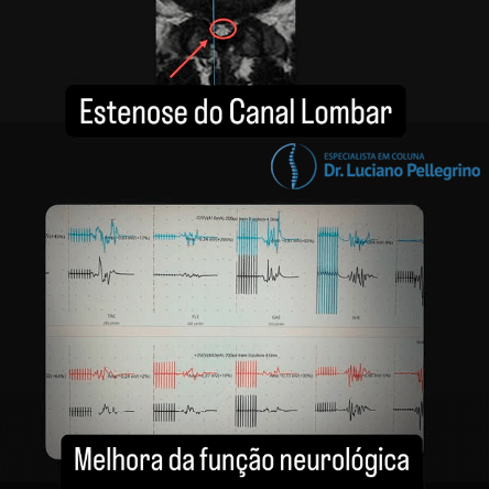 melhora da função neurológica