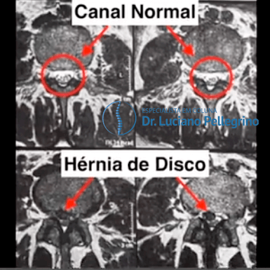 hérnia de disco
