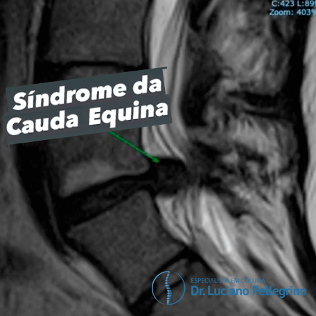 síndrome da cauda equina