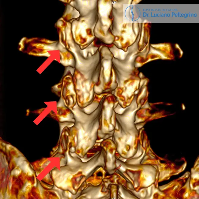 tomografia 3D de artrose na coluna (facetas)