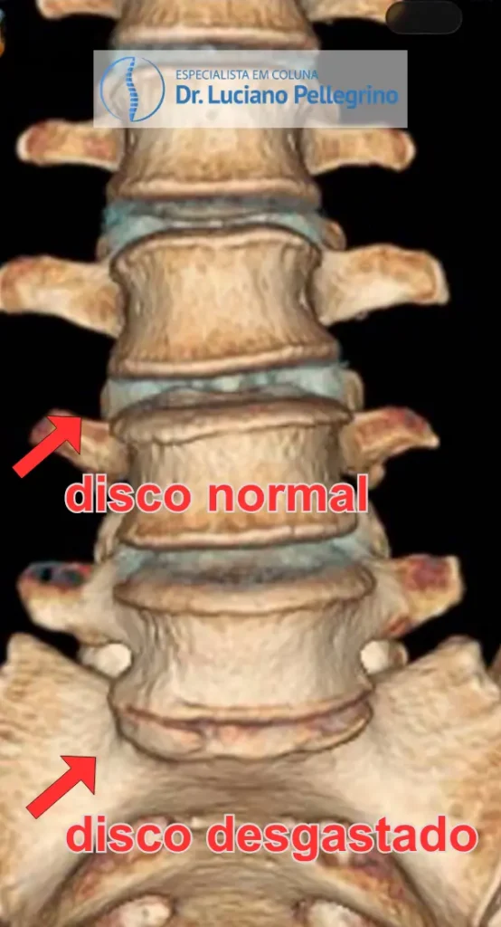 Tomografia 3D mostrando o último disco também com desgaste (mais achatado)